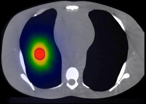 targeted radiation via high-energy electrons directed into a model lung