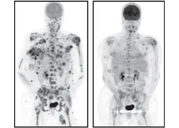 PET scan showing decrease in melanoma tumors using drug developed in part at SLAC (Image courtesy Plexxikon Inc.)