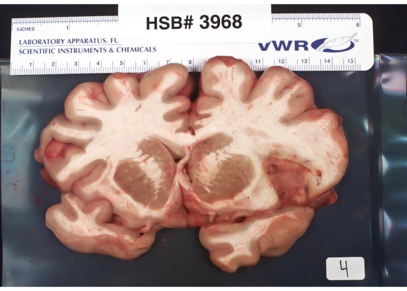 A slice of brain used for stroke research